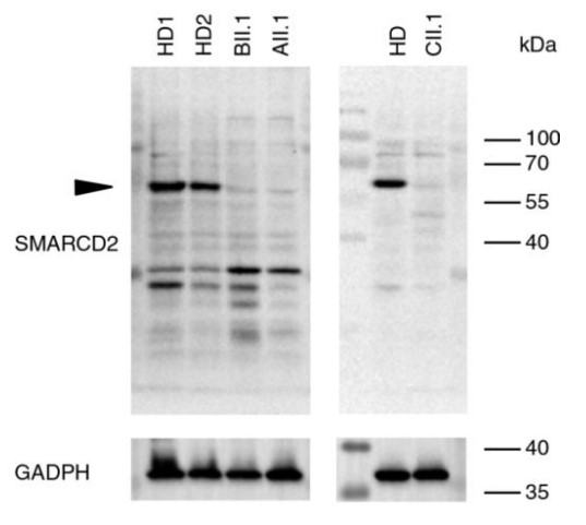 Immunoblot showing absence of SMARCD2 protein expression.jpg